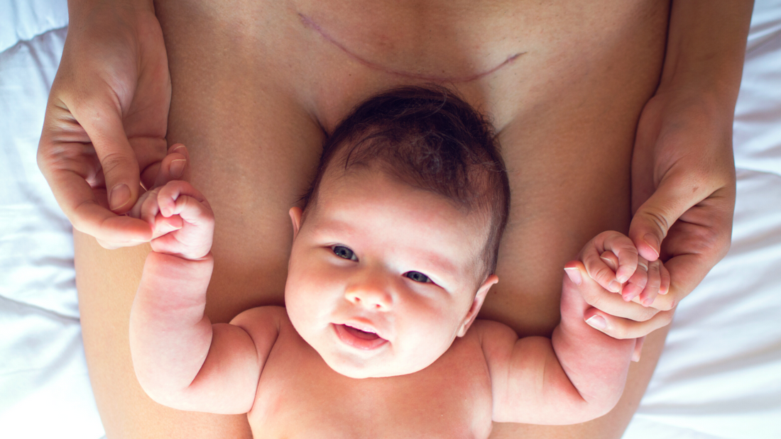 International Caesarean Awareness Month